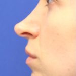 Septoplasty Before & After Patient #13539
