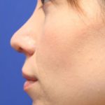 Septoplasty Before & After Patient #13539
