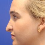 Septoplasty Before & After Patient #13537