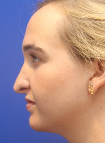 Septoplasty Before & After Patient #13537