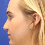 Septoplasty Before & After Patient #13537
