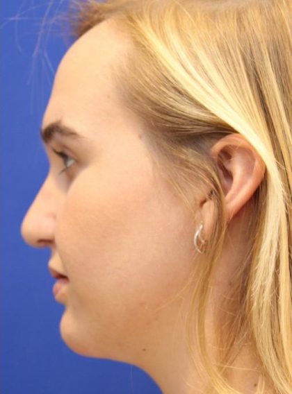 Septoplasty Before & After Patient #13537