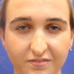 Septoplasty Before & After Patient #13537