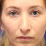 Septoplasty Before & After Patient #13541