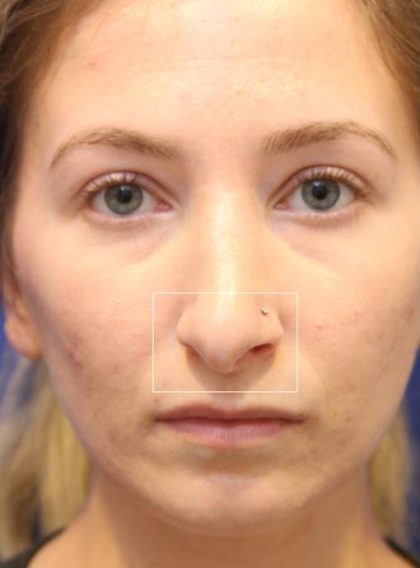 Septoplasty Before & After Patient #13541