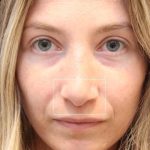Septoplasty Before & After Patient #13541