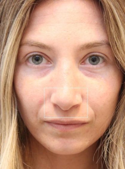 Septoplasty Before & After Patient #13541