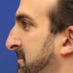 Septoplasty Before & After Patient #13545