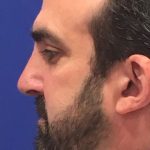Septoplasty Before & After Patient #13545