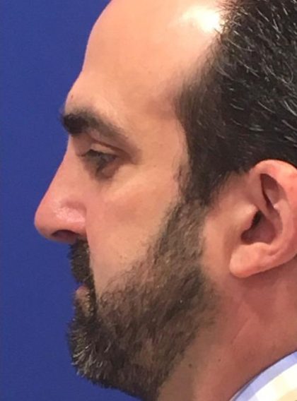 Septoplasty Before & After Patient #13545