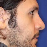 Septoplasty Before & After Patient #13543
