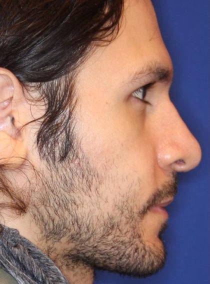 Septoplasty Before & After Patient #13543