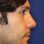 Septoplasty Before & After Patient #13543