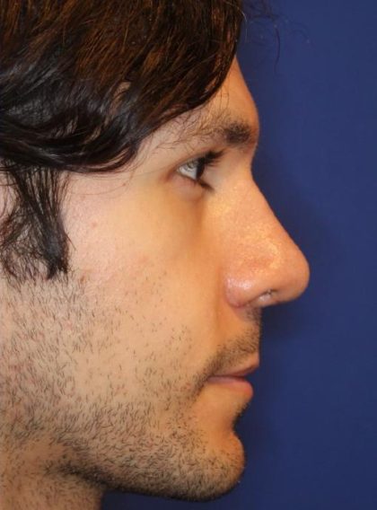 Septoplasty Before & After Patient #13543