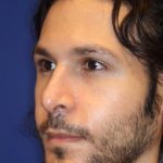 Septoplasty Before & After Patient #13543