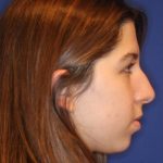 Septoplasty Before & After Patient #13547