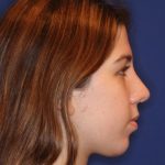 Septoplasty Before & After Patient #13547