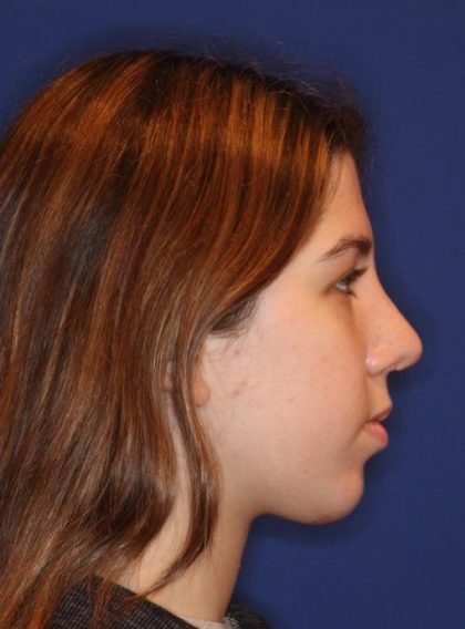 Septoplasty Before & After Patient #13547