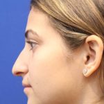 Septoplasty Before & After Patient #13549
