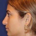 Septoplasty Before & After Patient #13549