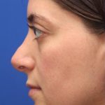 Septoplasty Before & After Patient #13551