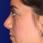Septoplasty Before & After Patient #13551