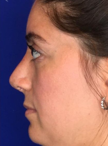 Septoplasty Before & After Patient #13551