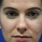 Skin Resurfacing & IPL Lasers Before & After Patient #13153
