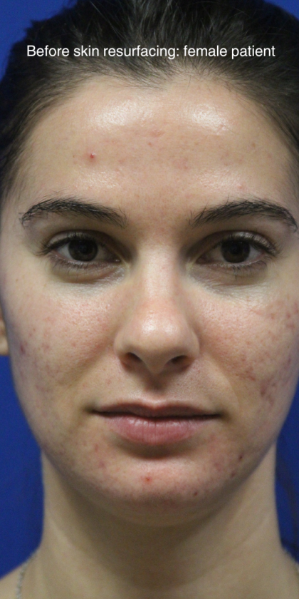 Skin Resurfacing & IPL Lasers Before & After Patient #13153