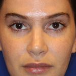 Skin Resurfacing & IPL Lasers Before & After Patient #13153