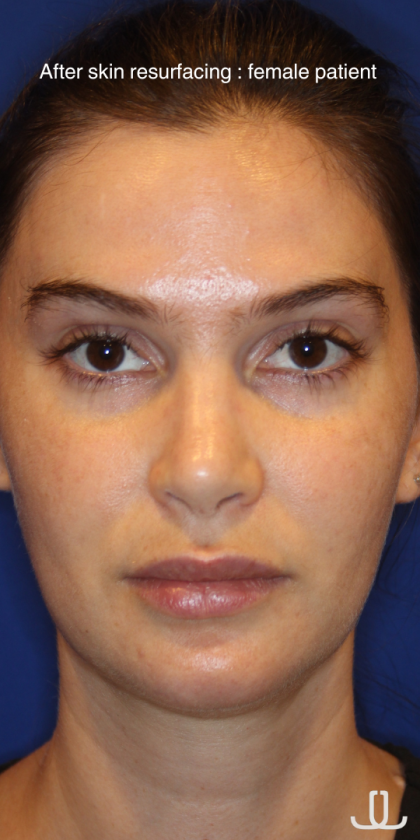 Skin Resurfacing & IPL Lasers Before & After Patient #13153