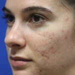 Skin Resurfacing & IPL Lasers Before & After Patient #13153
