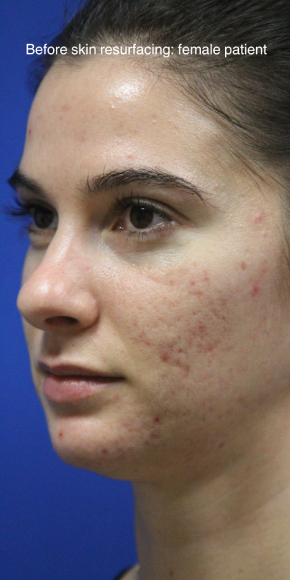 Skin Resurfacing & IPL Lasers Before & After Patient #13153