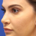 Skin Resurfacing & IPL Lasers Before & After Patient #13153