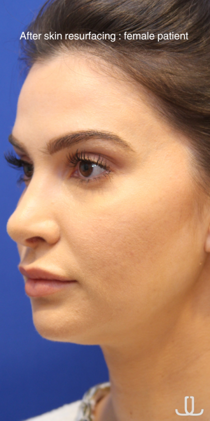 Skin Resurfacing & IPL Lasers Before & After Patient #13153