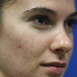 Skin Resurfacing & IPL Lasers Before & After Patient #13153