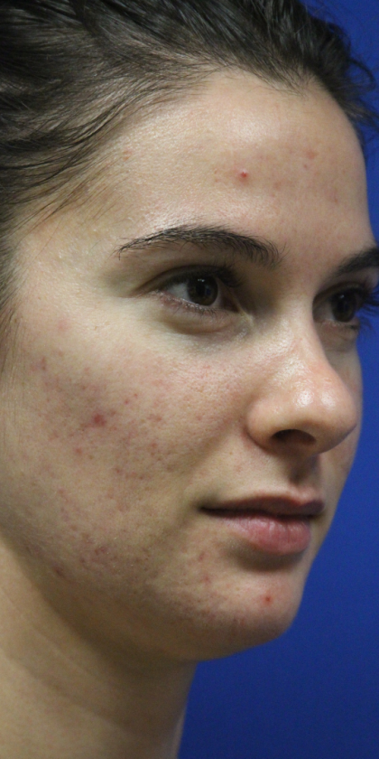 Skin Resurfacing & IPL Lasers Before & After Patient #13153