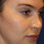 Skin Resurfacing & IPL Lasers Before & After Patient #13153