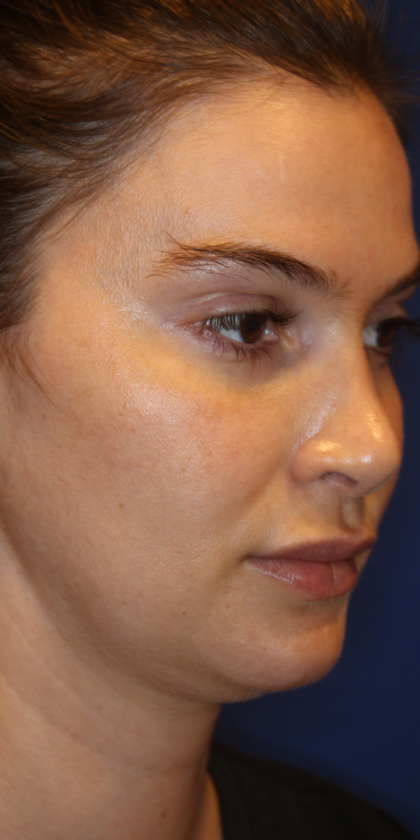Skin Resurfacing & IPL Lasers Before & After Patient #13153