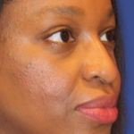 PDO Thread Lift Before & After Patient #13894