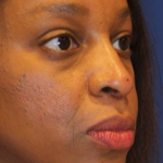 PDO Thread Lift Before & After Patient #13894