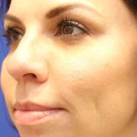 PDO Thread Lift Before & After Patient #13897