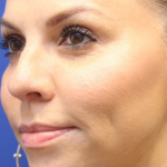 PDO Thread Lift Before & After Patient #13897
