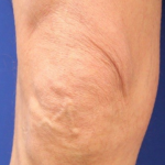 Ultherapy Before & After Patient #15896