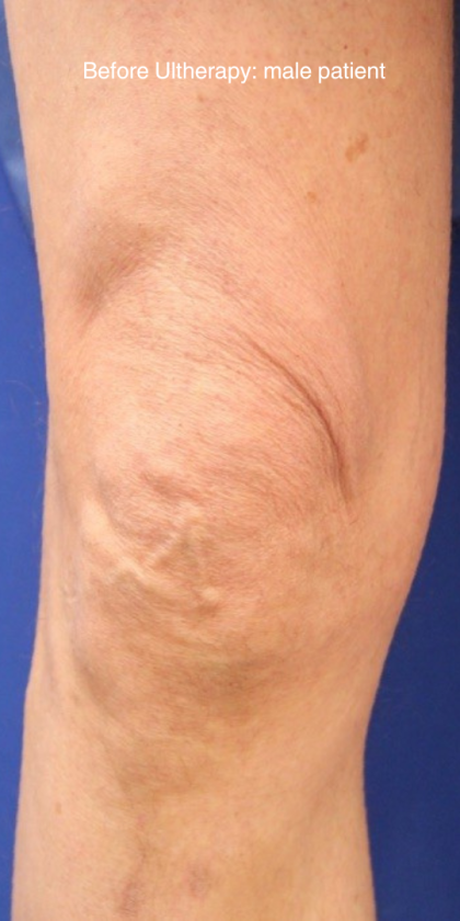 Ultherapy Before & After Patient #15896