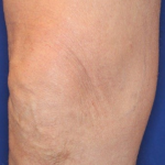 Ultherapy Before & After Patient #15896