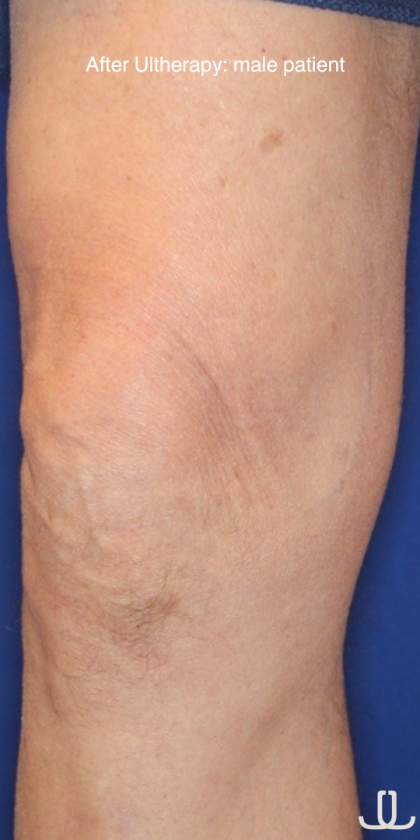 Ultherapy Before & After Patient #15896