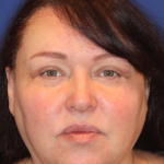 Ultherapy Before & After Patient #15608