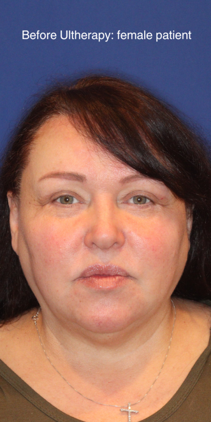Ultherapy Before & After Patient #15608