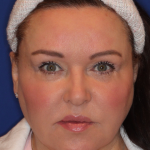 Ultherapy Before & After Patient #15608